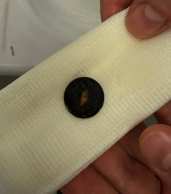 В Альметьевске врачи спасли малыша, проглотившего монету